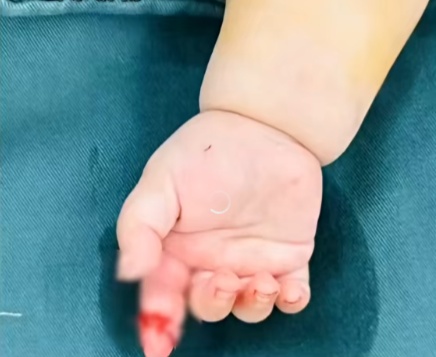 女子抱娃拆快递剪断婴儿手指