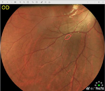 24岁小伙每周四五杯奶茶眼中风突然失明，医生：日常应限制高糖高脂食物摄入量