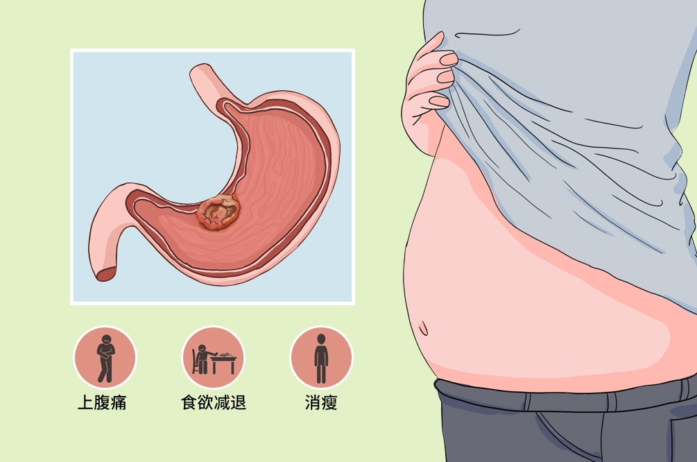 补血越补越虚？身体出现这3个异常，警惕胃癌来袭
