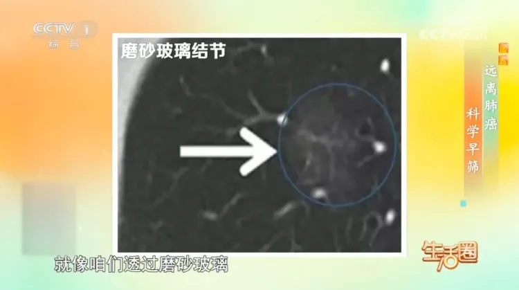 早期大多无症状！身体出现这6种情况，可能是肺癌的信号→
