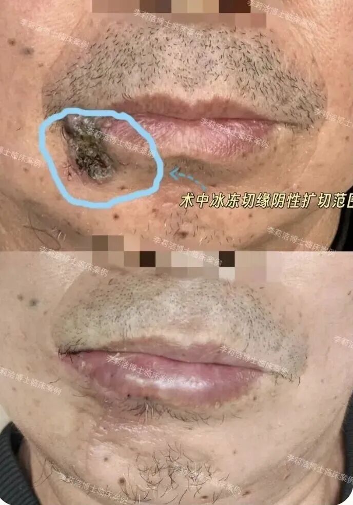 东莞一男子把唇上肿瘤当痘痘挤了8年