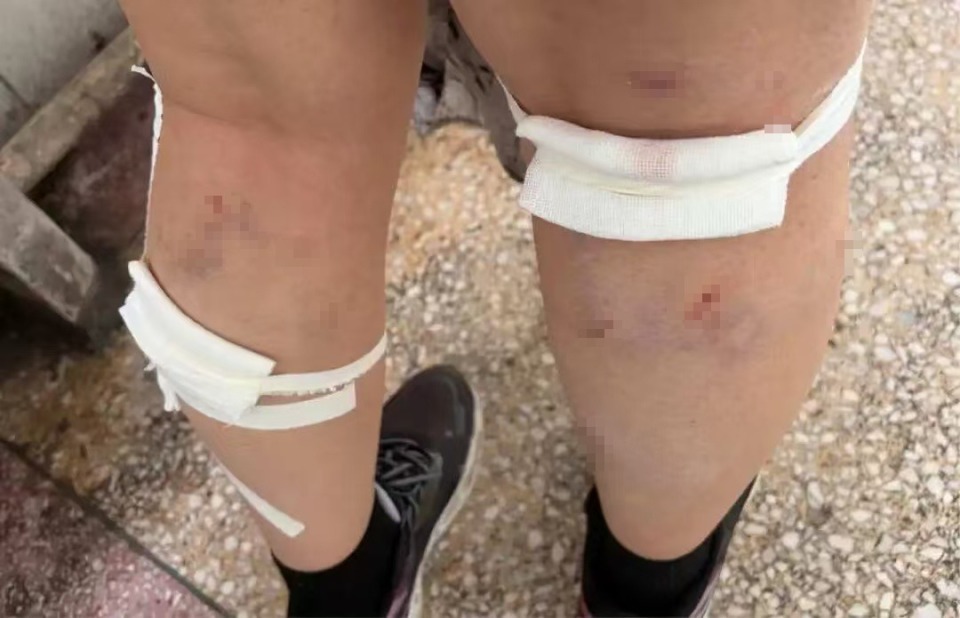 平顶山学院女生校内被一群流浪狗咬伤，校方：有两名学生帮忙驱赶，已制定了解决方案