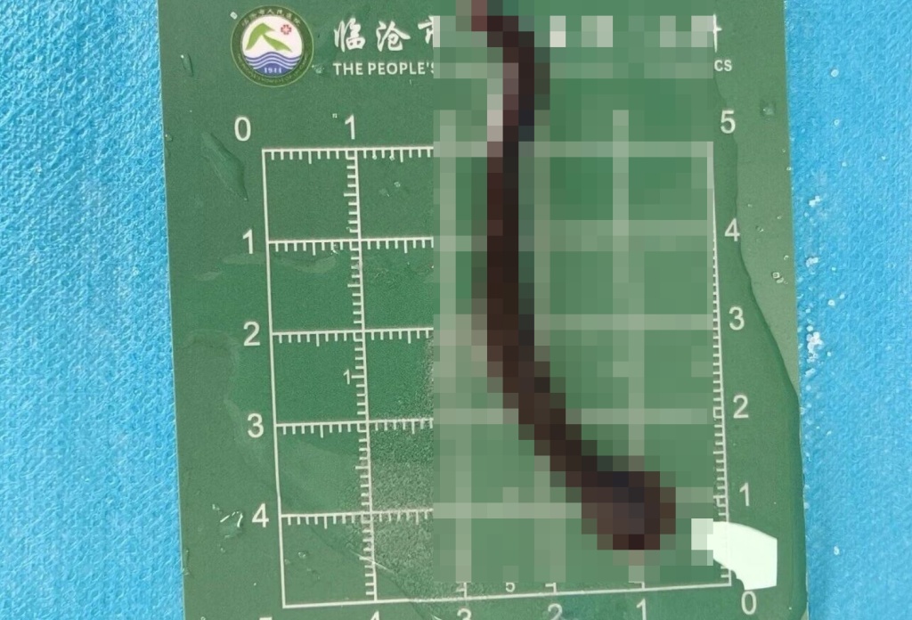 云南一8岁儿童十余天反复咳痰带血，气管内取出8厘米活体蠕动蚂蟥