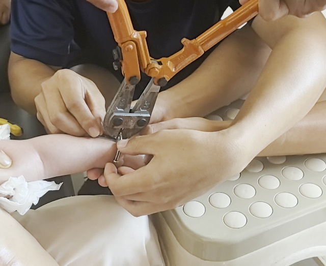 老人烫伤后戒指卡住肿胀手指 消防十分钟精准剪切