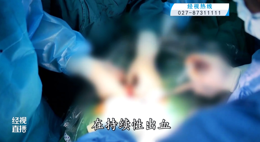 紧急抢救！武汉准妈妈腹痛硬扛一周，子宫破裂出血800毫升