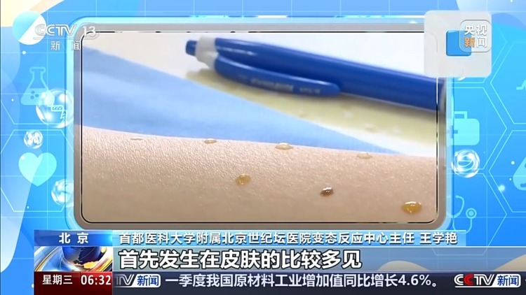 别把过敏当小事 医生提醒：出现这些症状可能是休克前兆