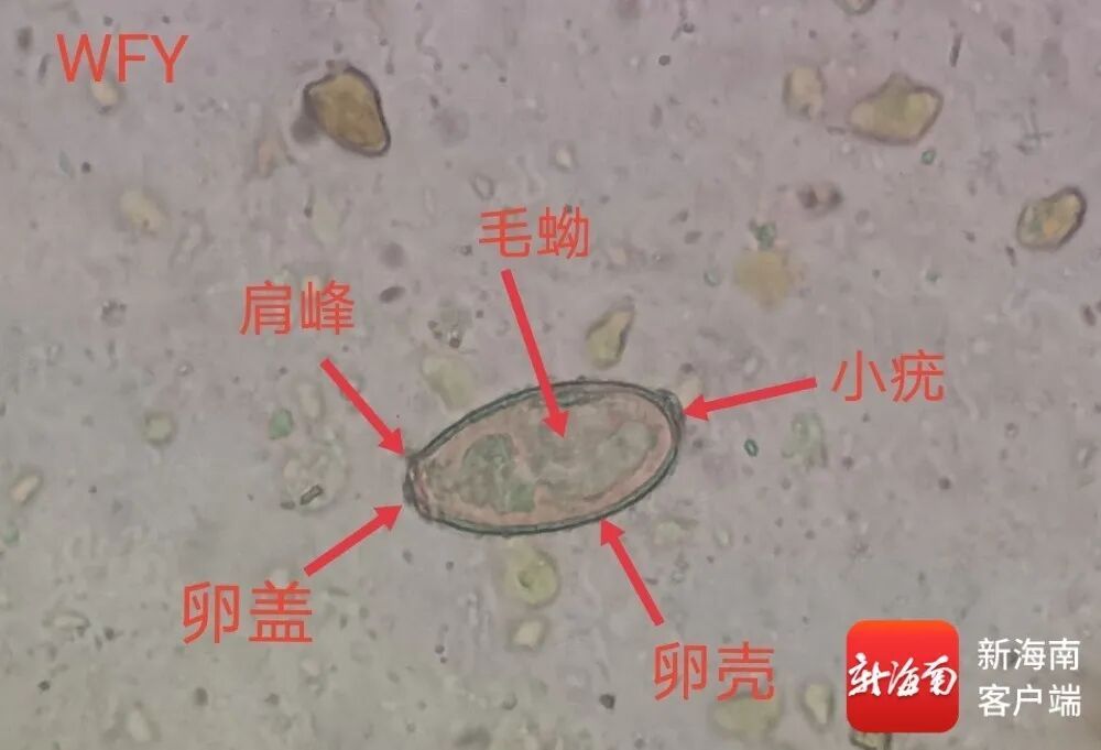 海口一高中生吃“淡水鱼生”反复发热腹痛，医师花2小时粪检找出寄生虫