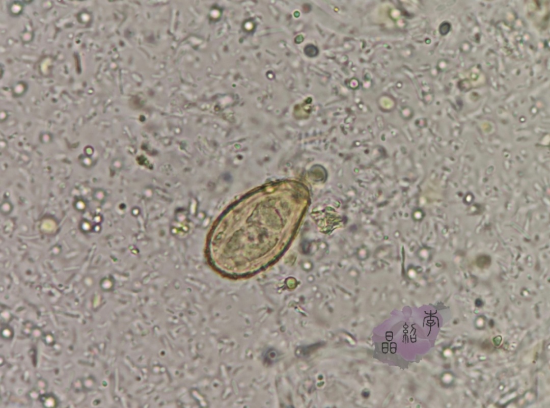 海口一高中生吃“淡水鱼生”反复发热腹痛，医师花2小时粪检找出寄生虫