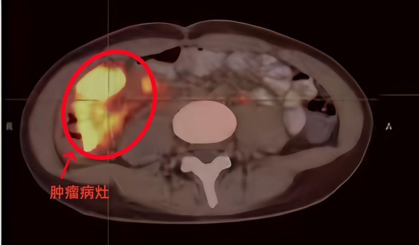 14岁女孩腹痛半年，确诊晚期癌……常规体检≠癌症筛查，这些高危人群不能等！