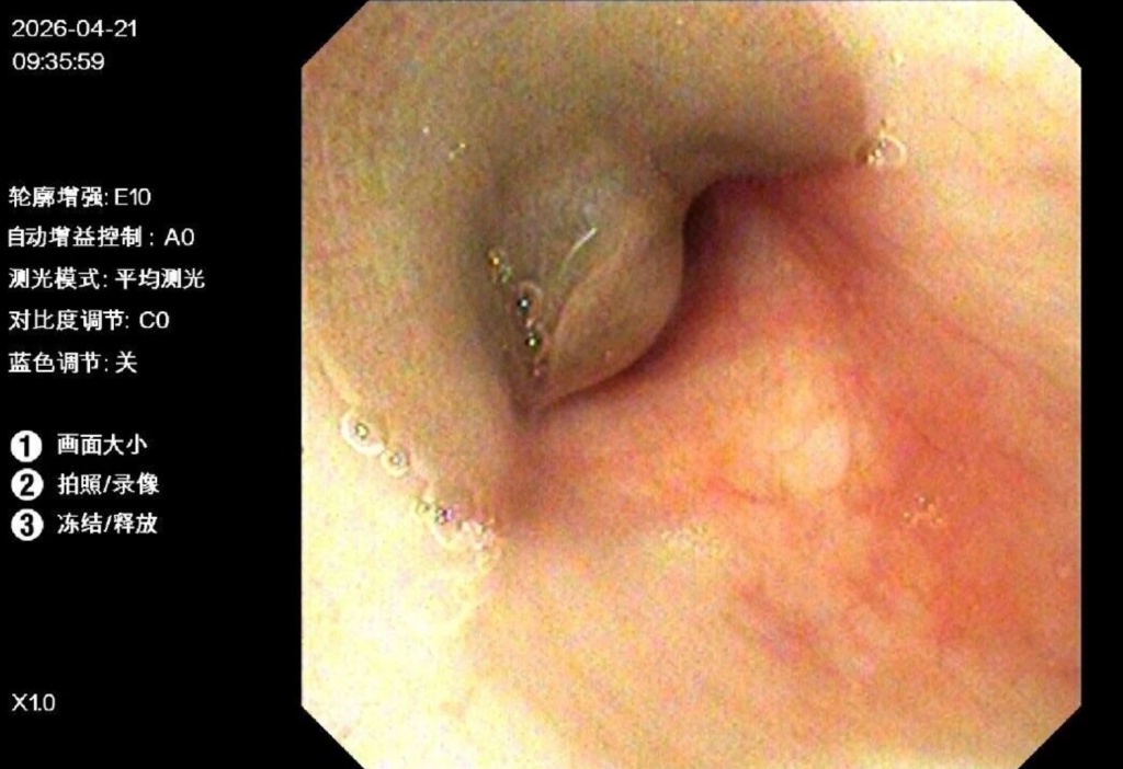 8岁幼童气管内取出8厘米活体蚂蟥：吸附在黏膜上，几乎堵塞整个气道，医生提醒→