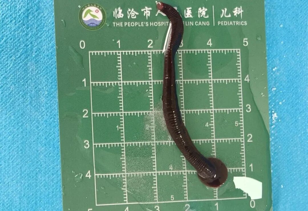 头皮发麻！云南一8岁孩子气管内取出8厘米活体蚂蟥，半年前还曾从鼻腔内取出…