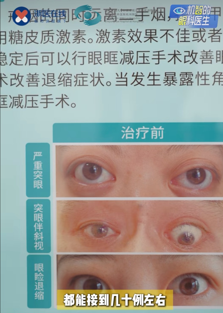 夸张！女子双眼突出，鼓得像青蛙！“无法忽视……”医生一个月接诊超100例