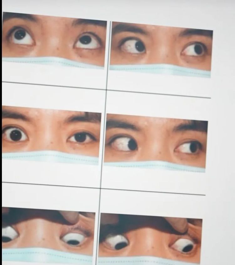 夸张！女子双眼突出，鼓得像青蛙！“无法忽视……”医生一个月接诊超100例