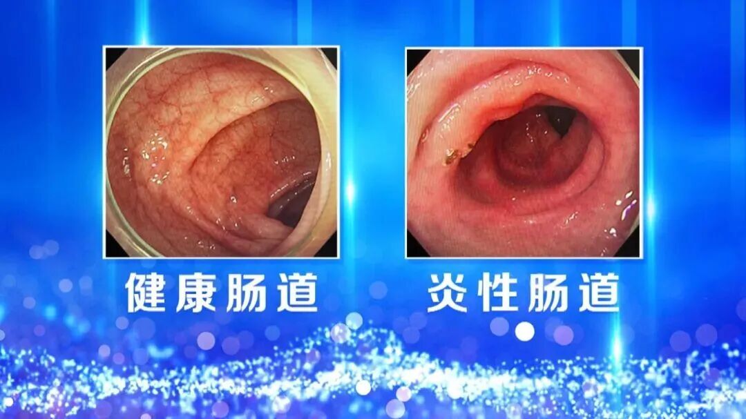 便秘别硬扛，出现这几种情况，可能是癌症信号