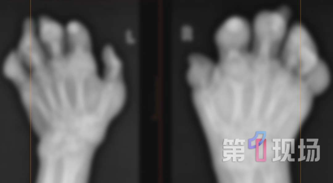 一天三杯奶茶，28岁男子手指脚趾长出“巨石”