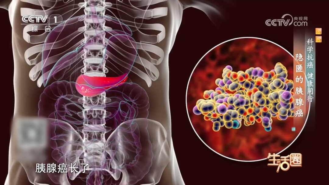 胃不适、腰背酸、血糖高？警惕“癌王”发出的预警信号