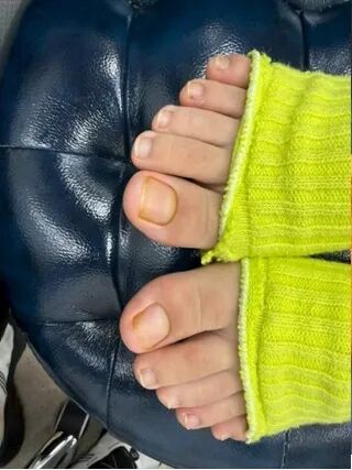 杭州姑娘脚趾甲发黄增厚，变成“千层糕”，被误认灰指甲，这个习惯不要再做了...