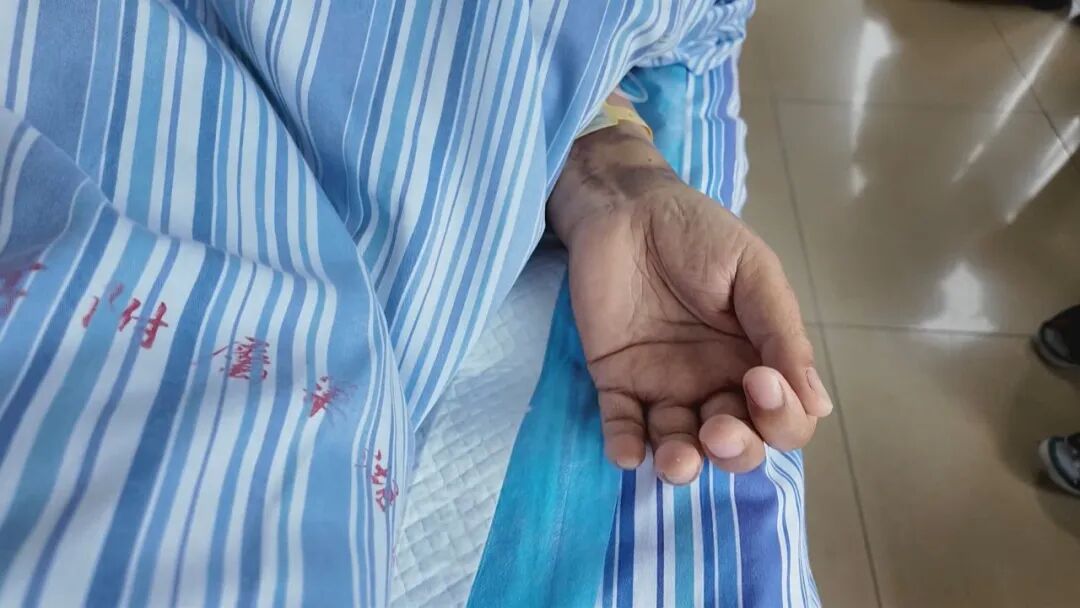 巢湖一老人在家捉蝙蝠，没想到第二天开始发热最终住进ICU！医生提醒：警惕这种罕见病