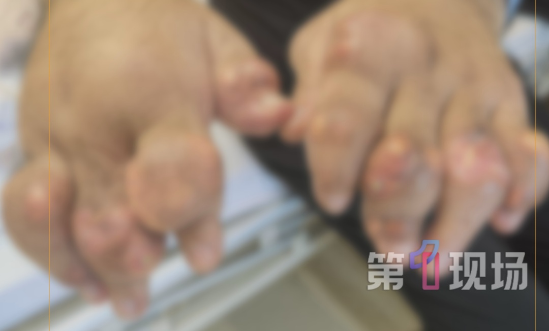 一天三杯奶茶，28岁男子手指脚趾长出“巨石”