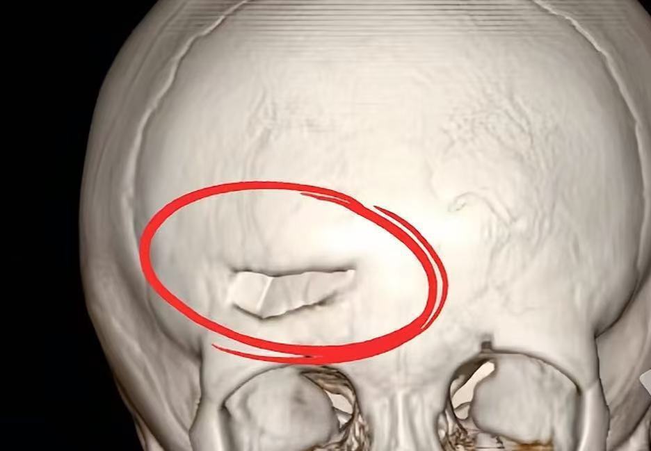 东莞5岁男孩公园内被14岁少年骑电动车撞致头骨骨折，当地最新回应