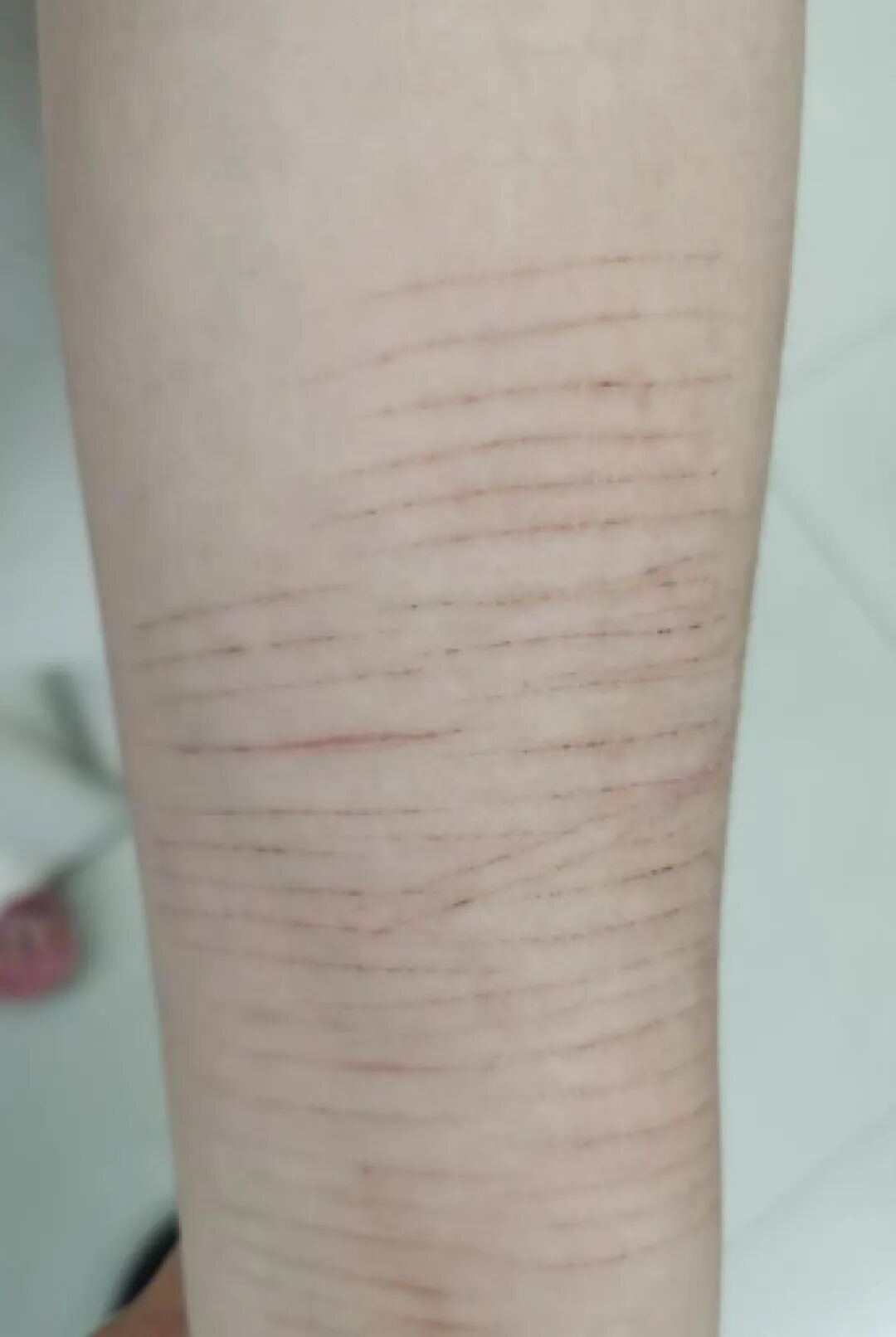 14岁女生胳膊上满是划痕，老师坚持让家长带去看病，家长：她能吃能睡没问题