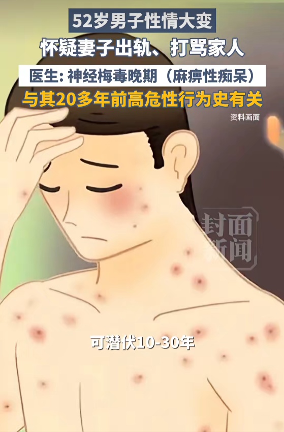 52岁男子性情大变，总怀疑妻子出轨！竟因自己患上神经梅毒晚期...