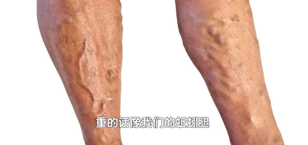 一个常见的习惯堵血管，动动脚预防血栓