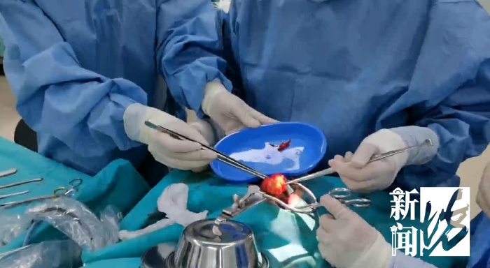 “畸胎瘤残留在咽喉”，有软骨有脂肪！6岁男孩饮食习惯不对劲，上海医生一查惊了……