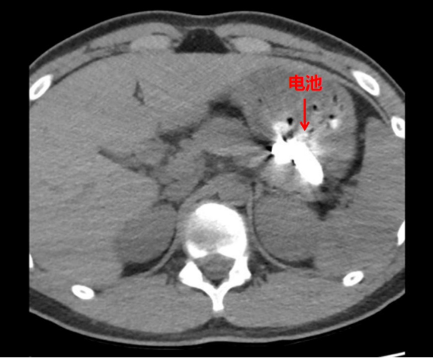 少年咬破两枚电池，随后误喝水将电池残骸吞入腹中！医生在其清醒状态下顺利取出