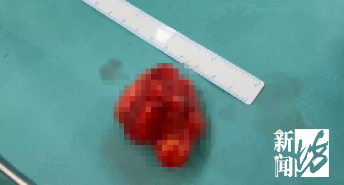 “畸胎瘤残留在咽喉”，有软骨有脂肪！6岁男孩饮食习惯不对劲，上海医生一查惊了……