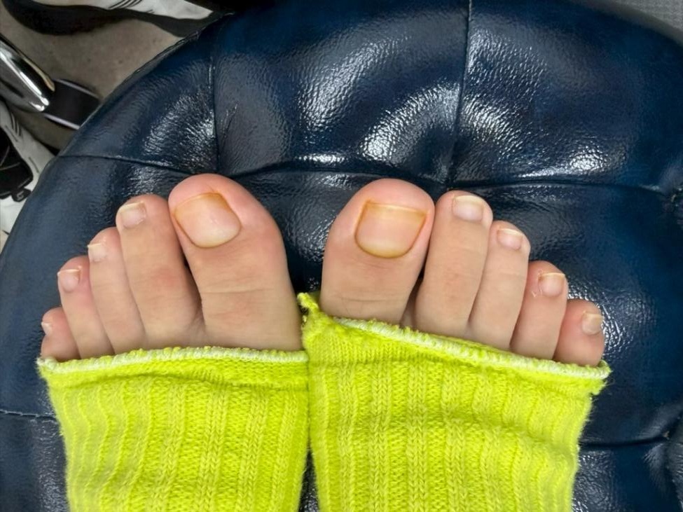 26岁杭州女子脚趾甲成“千层糕”，走路都困难，医生：只能拔掉！