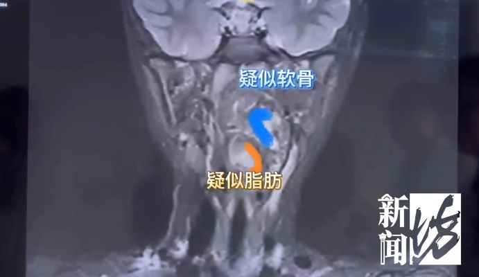 “畸胎瘤残留在咽喉”，有软骨有脂肪！6岁男孩饮食习惯不对劲，上海医生一查惊了……