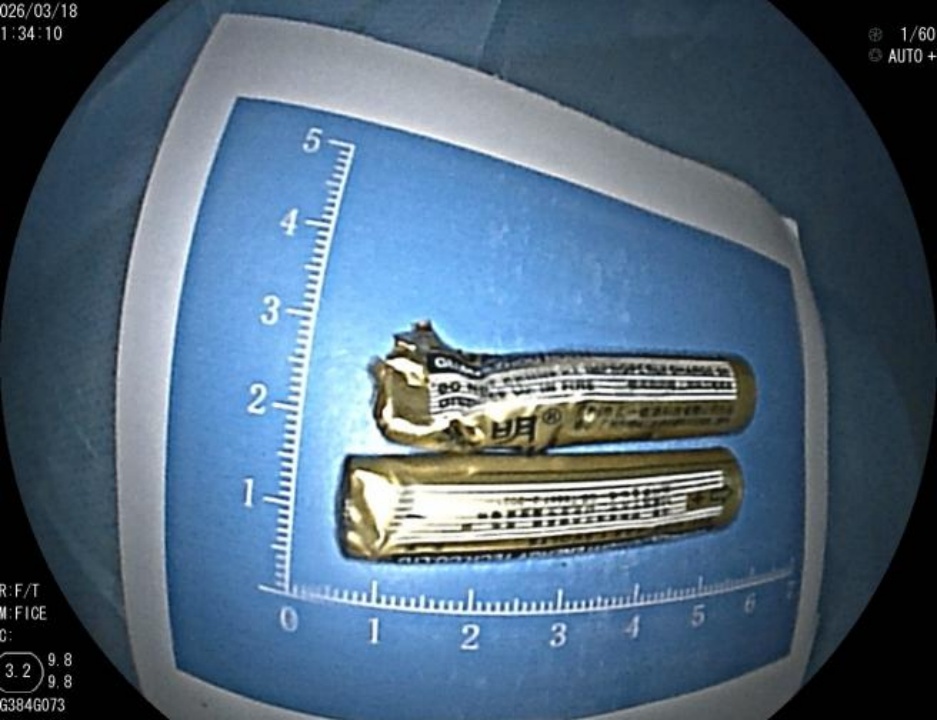 少年咬破两枚电池，随后误喝水将电池残骸吞入腹中！医生在其清醒状态下顺利取出