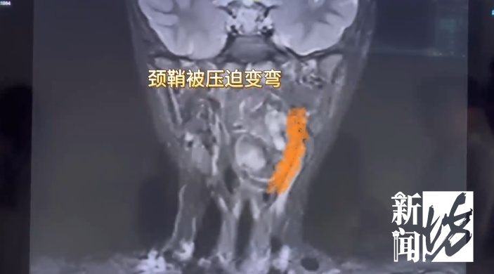 “畸胎瘤残留在咽喉”，有软骨有脂肪！6岁男孩饮食习惯不对劲，上海医生一查惊了……