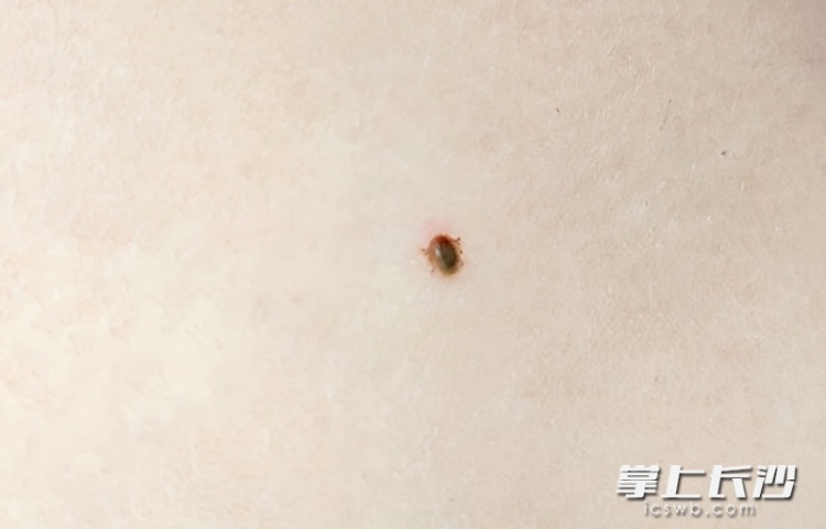 危险！身上突然冒出这种小黑点，要尽快处理