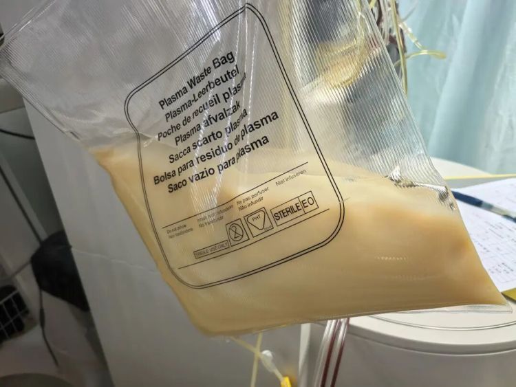 温州一男子酒后抽出“草莓奶油血”！医生提醒：高血脂变急性胰腺炎只差一个诱因……