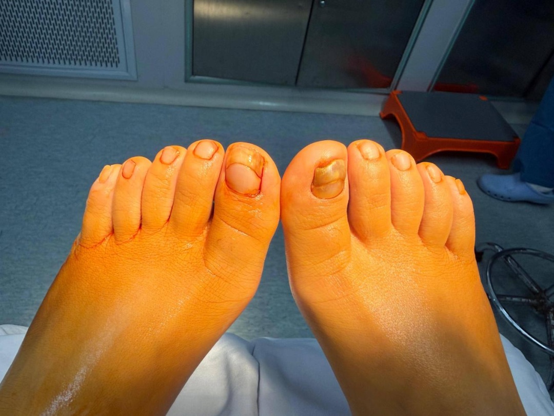 26岁杭州女子脚趾甲成“千层糕”，走路都困难，医生：只能拔掉！