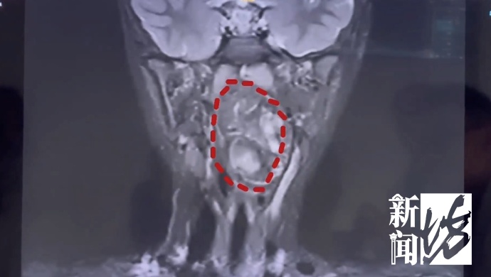 “双胞胎兄弟残留在咽喉”，有软骨有脂肪！6岁男孩饮食习惯不对劲，医生一查惊了…