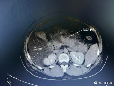 14岁男孩一顿狂炫6个鸡腿和几大块红烧肉，突发急性胰腺炎被下病危通知书