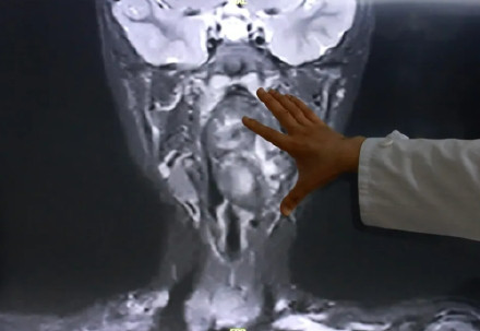 罕见！"双胞胎兄弟残留在咽喉"，有脂肪有软骨