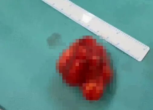 6岁男孩长期打鼾、挑食，喉咙里竟取出“双胞胎兄弟”！医生：极其罕见