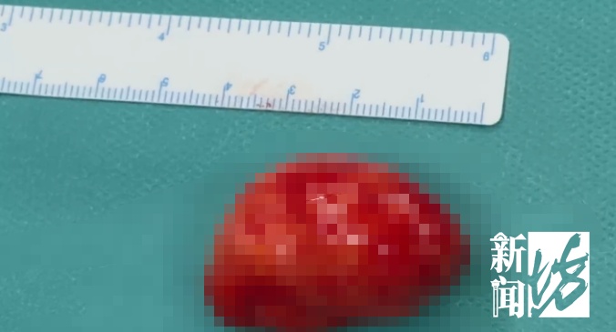 “双胞胎兄弟残留在咽喉”，有软骨有脂肪！6岁男孩饮食习惯不对劲，医生一查惊了…