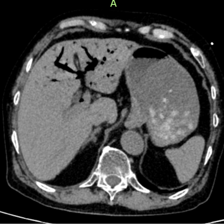 一口“舍不得”，台州76岁老人突发休克出现“死神之征”！医生紧急提醒