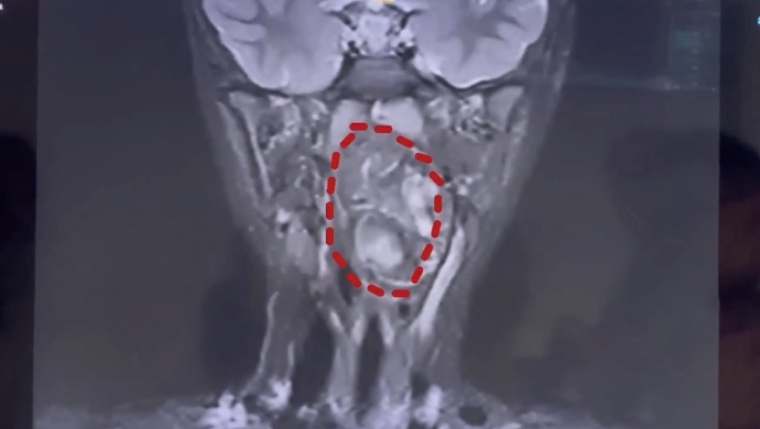 6岁男孩长期打鼾、挑食，喉咙里竟取出“双胞胎兄弟”！医生：极其罕见