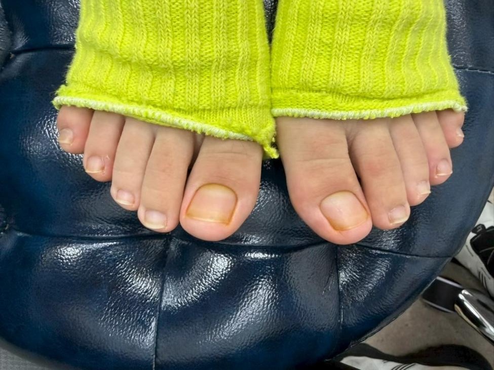 26岁姑娘脚趾甲变"千层糕"，被误认灰指甲！很多人有这个习惯