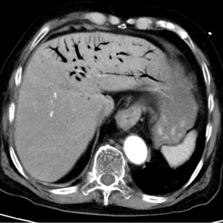 一口“舍不得”，台州76岁老人突发休克出现“死神之征”！医生紧急提醒