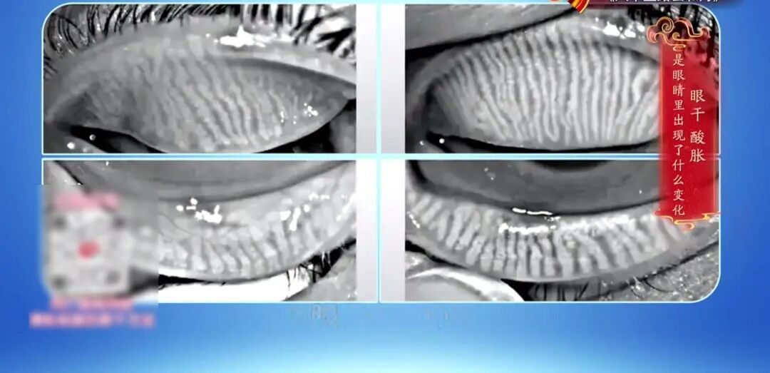 一个毁掉视力的习惯，你可能天天做，2个动作给双眼“补补水”，酸胀疲劳都赶跑