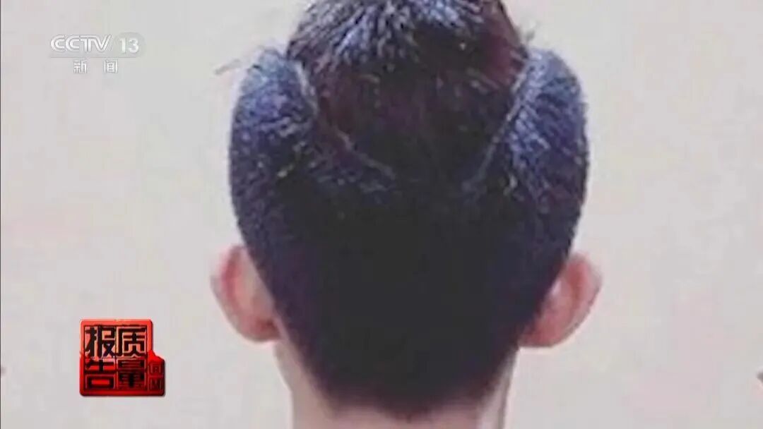 “麻药一过，生不如死”，央视揭秘“精灵耳”整形乱象：有人落下终身残疾