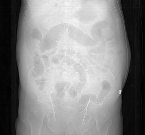 台州一男子吃了冰箱冷藏4天的鸡肉，突发休克，出现“死神之征”！医生紧急提醒