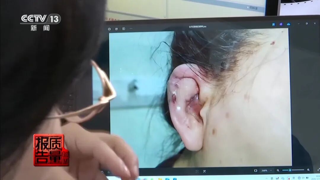 “精灵耳”背后的整形乱象：女子注射后落下终身残疾……